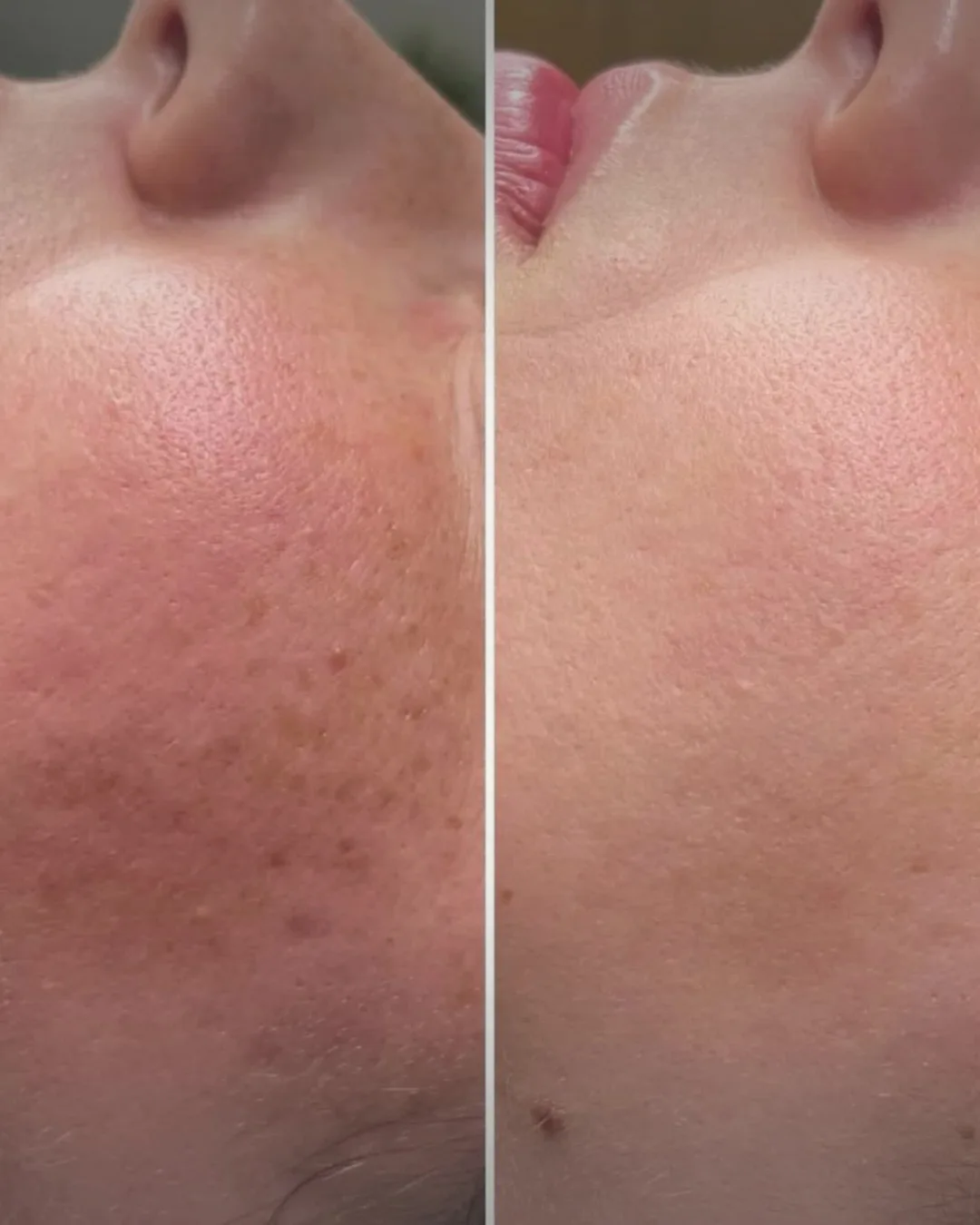 Before-and-after skin result — pigmentation treatment
